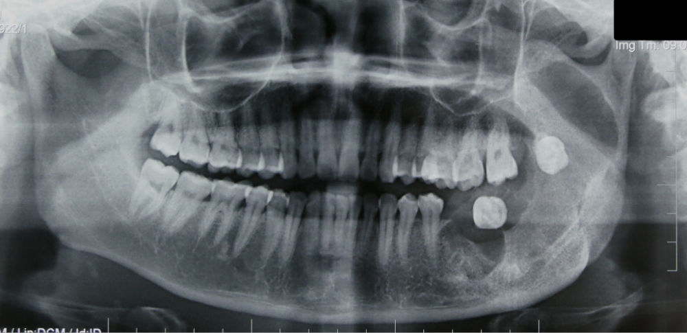 Oral and Maxillofacial pathology – Ameloblastoma