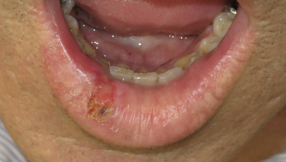 Oral and Maxillofacial pathology – Lower lip sun damage and cancer