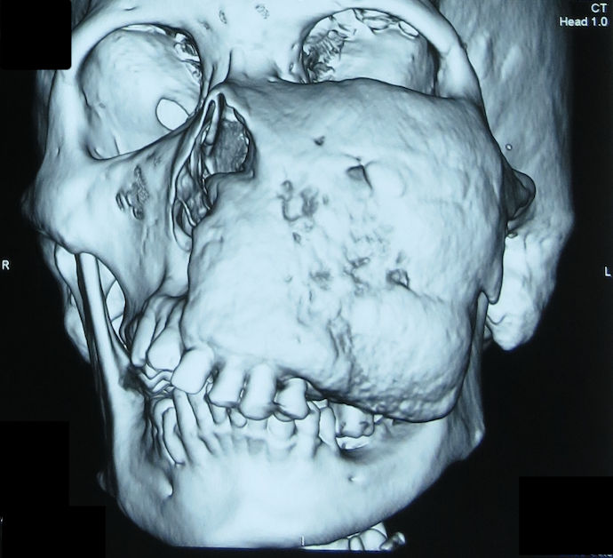 Oral and Maxillofacial pathology – large fibrous dysplasia lesion